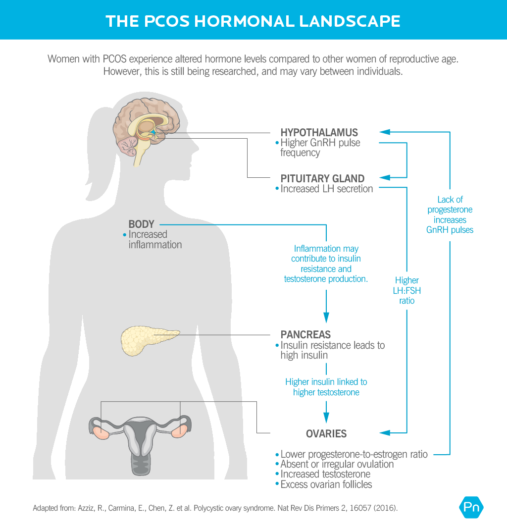 Anatomical figure of a woman. At the hypothalamus, there is a higher GnRH pulse frequency. At the pituitary gland, there is increased LH secretion. In the body, there is increased inflammation. In the pancreas, there is insulin resistance, leading to high insulin. In the ovaries, there is a lower progesterone-to-estrogen ratio, absent or irregular ovulation, increased testosterone, and excess ovarian follicles. An arrow shows that lack of progesterone from the ovaries contributes to higher GnRH pulse frequency.