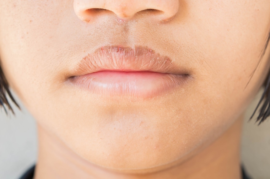 how to get rid of chapped lips dry lips