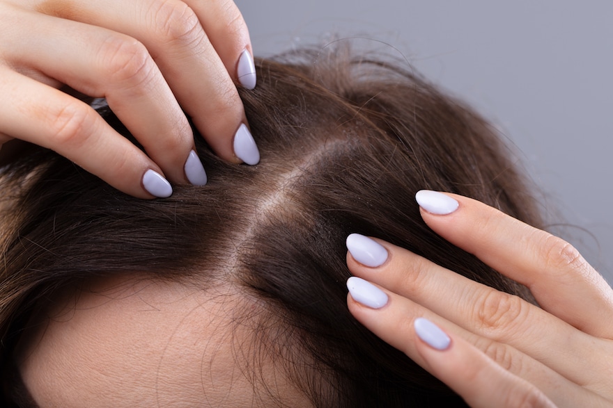 postpartum hair loss scalp