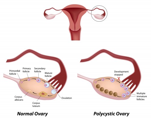 Tell Tale signs of PCOS