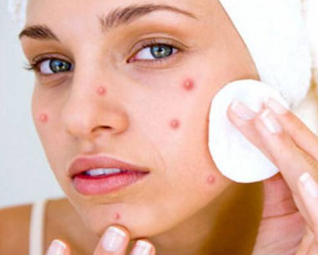Acne-Top 5 Amazing benefits of Tea Tree Essential Oil for skin health