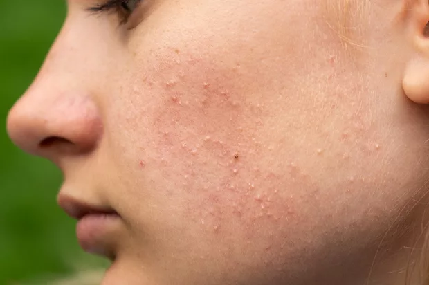 Close up of woman dealing with the retinol uglies, including breakouts, dryness, and irritation
