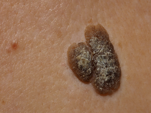 Keratosis