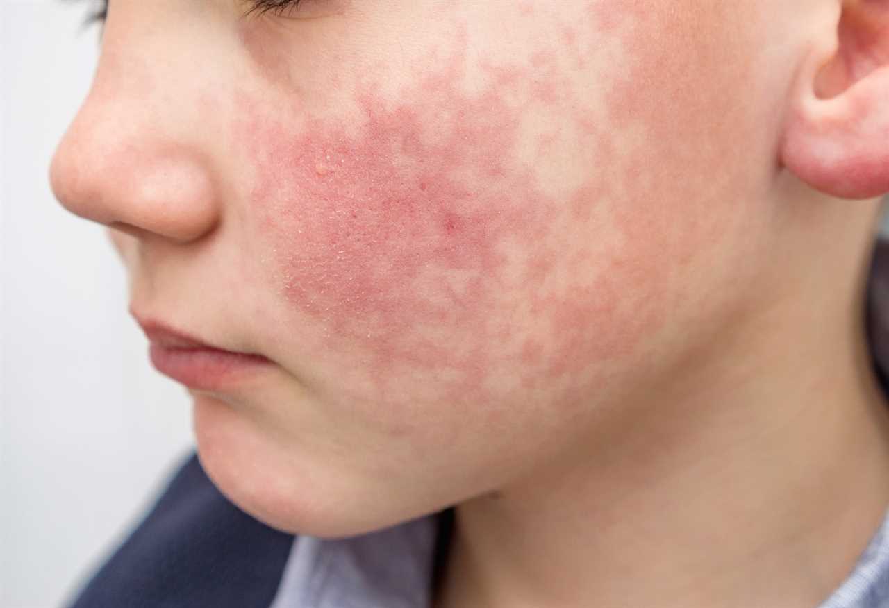 A young boy with slapped-cheek rash.