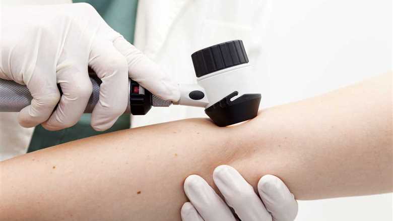 What to expect at a skin cancer screening