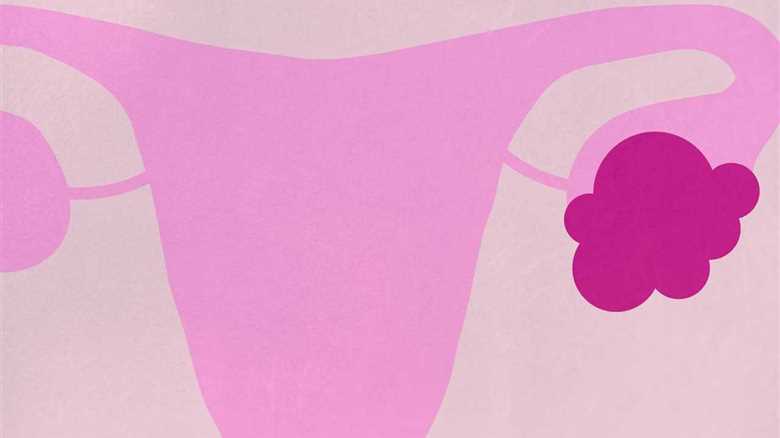 What to do if you are diagnosed with an Ovarian cyst