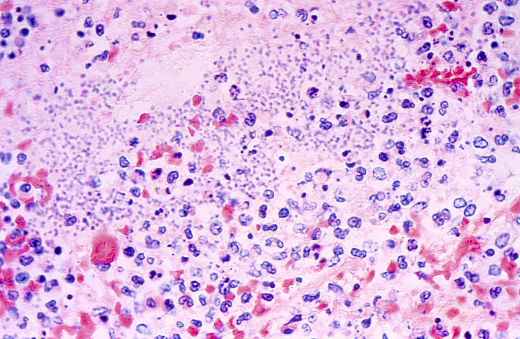 Fatal human plague