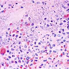 Pneumonic plague