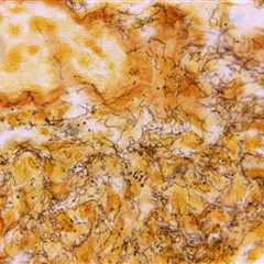 syphilis